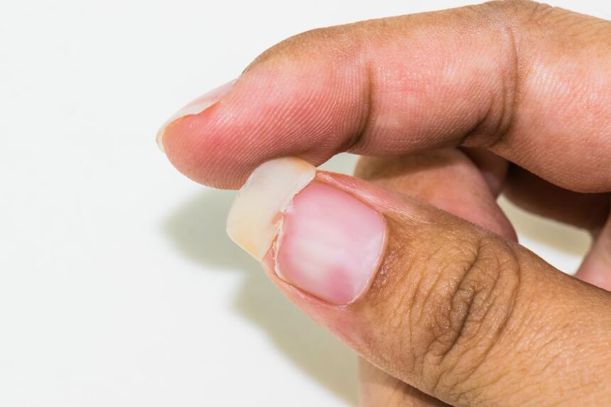 Uñas quebradizas